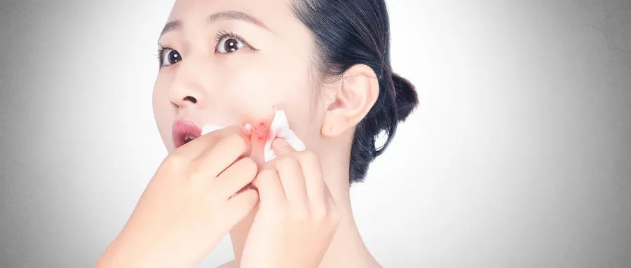 如何預(yù)防粉刺的發(fā)生和痤瘡的形成？