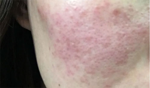 皮膚泛紅癢是什么原因？皮膚紅癢怎么回事？
