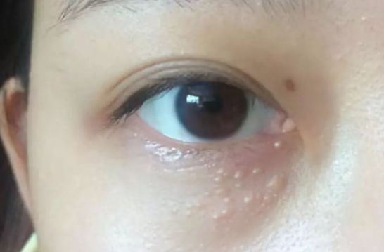 為什么眼部容易長脂肪粒？