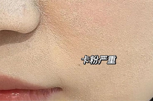 卡粉是什么意思？卡粉是什么原因引起的？