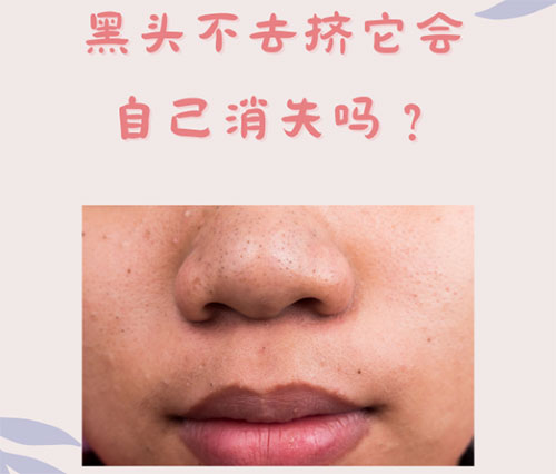 什么是黑頭？怎樣預(yù)防黑頭的形成？
